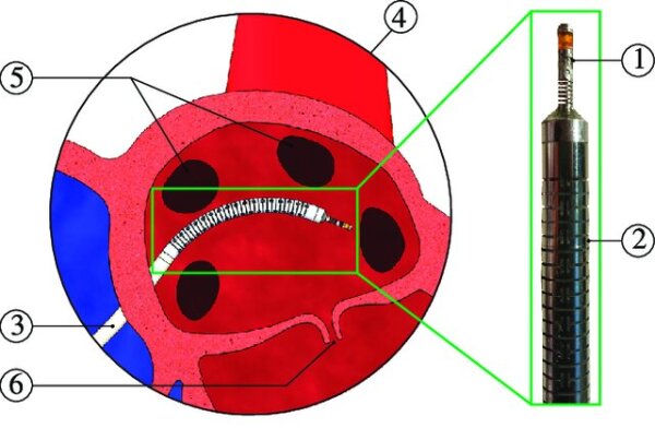 Three-dimensional catheter tip force sensing using multi-core fiber Bragg gratings main image
